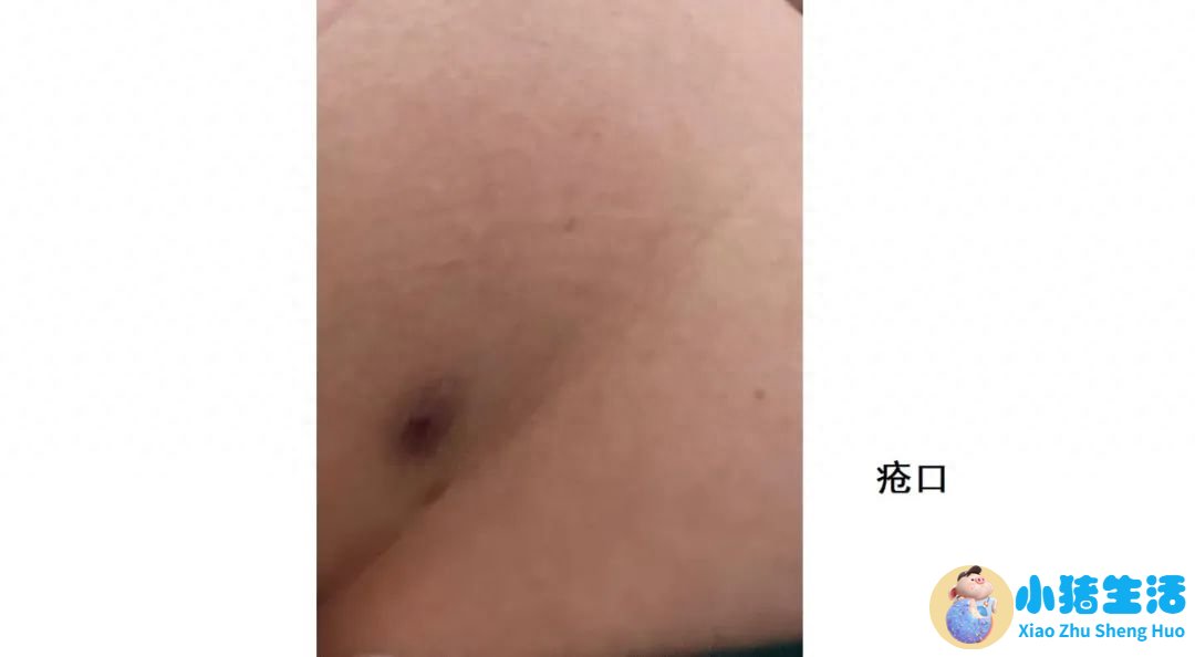 全身抽脂需要多少钱