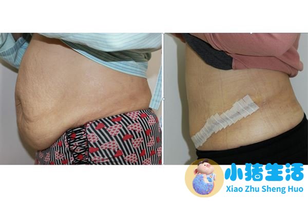 全身抽脂需要多少钱