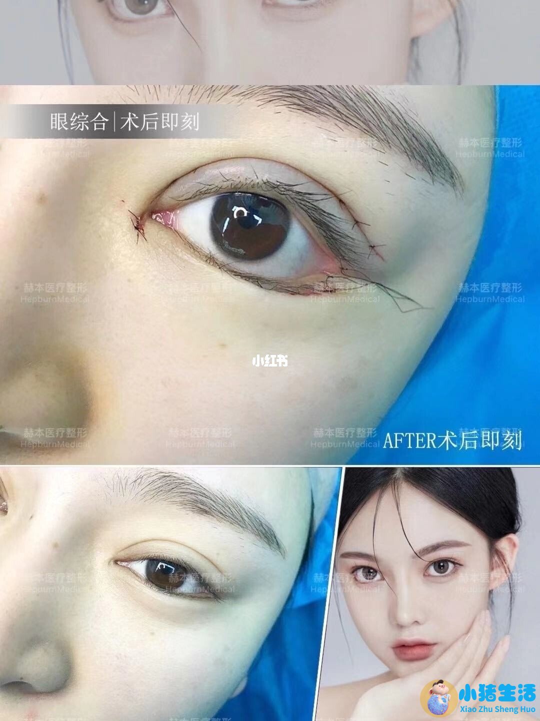 双眼皮整形失败的案例