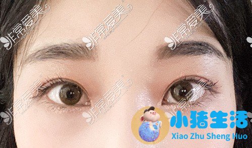 双眼皮整形失败的案例