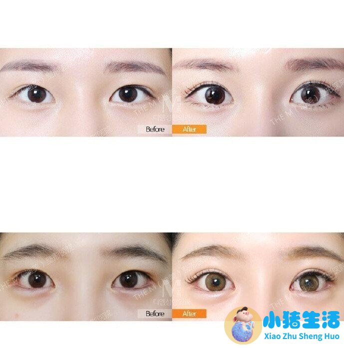 双眼皮整形失败的案例