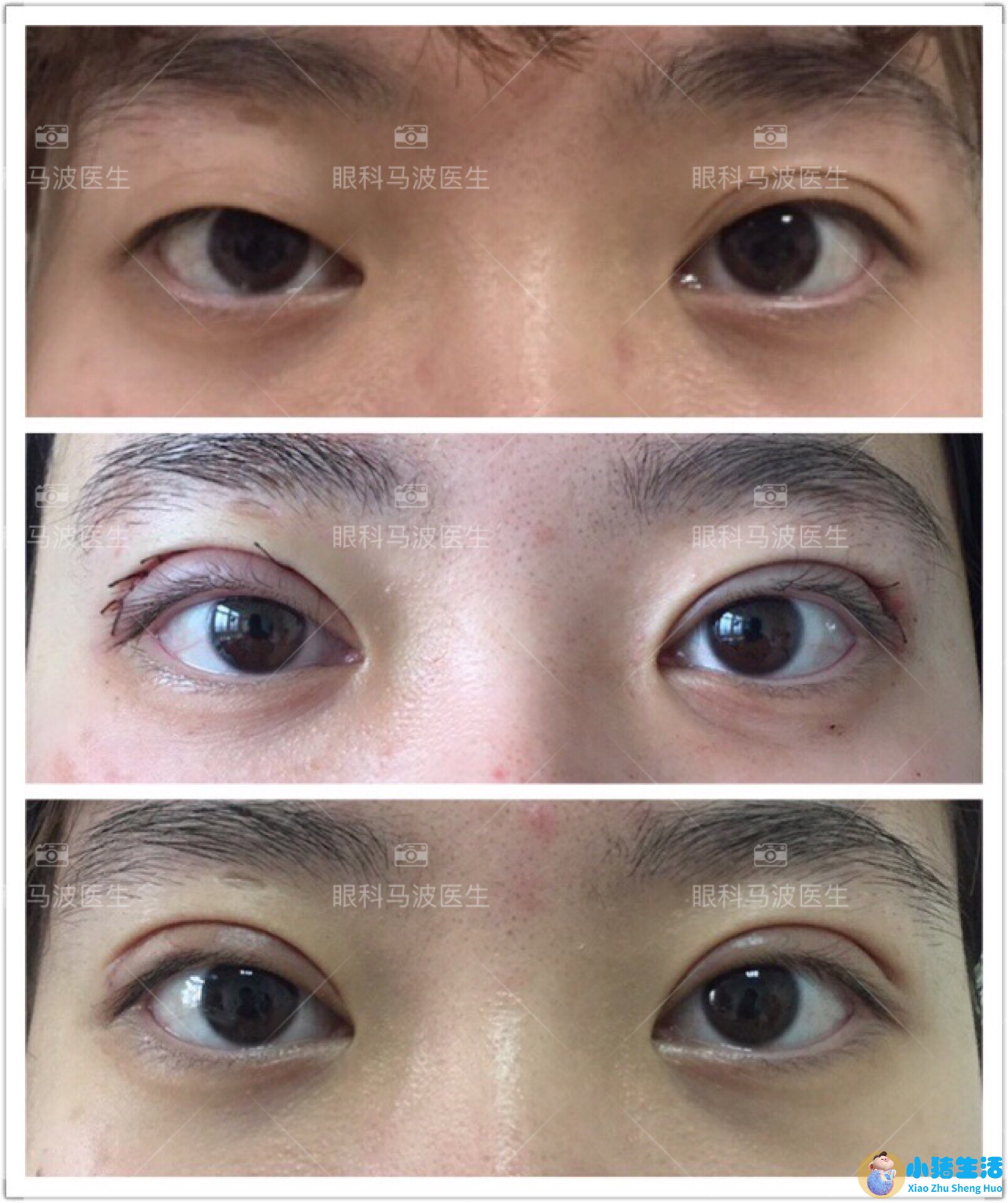 双眼皮整形失败的案例