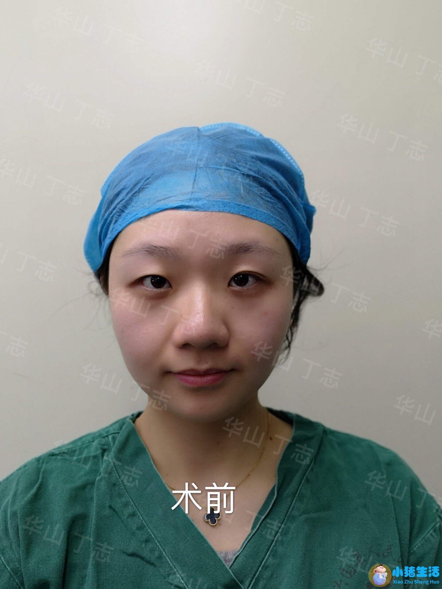 双眼皮整形失败的案例