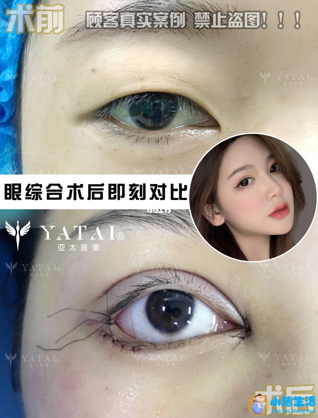 双眼皮整形失败的案例