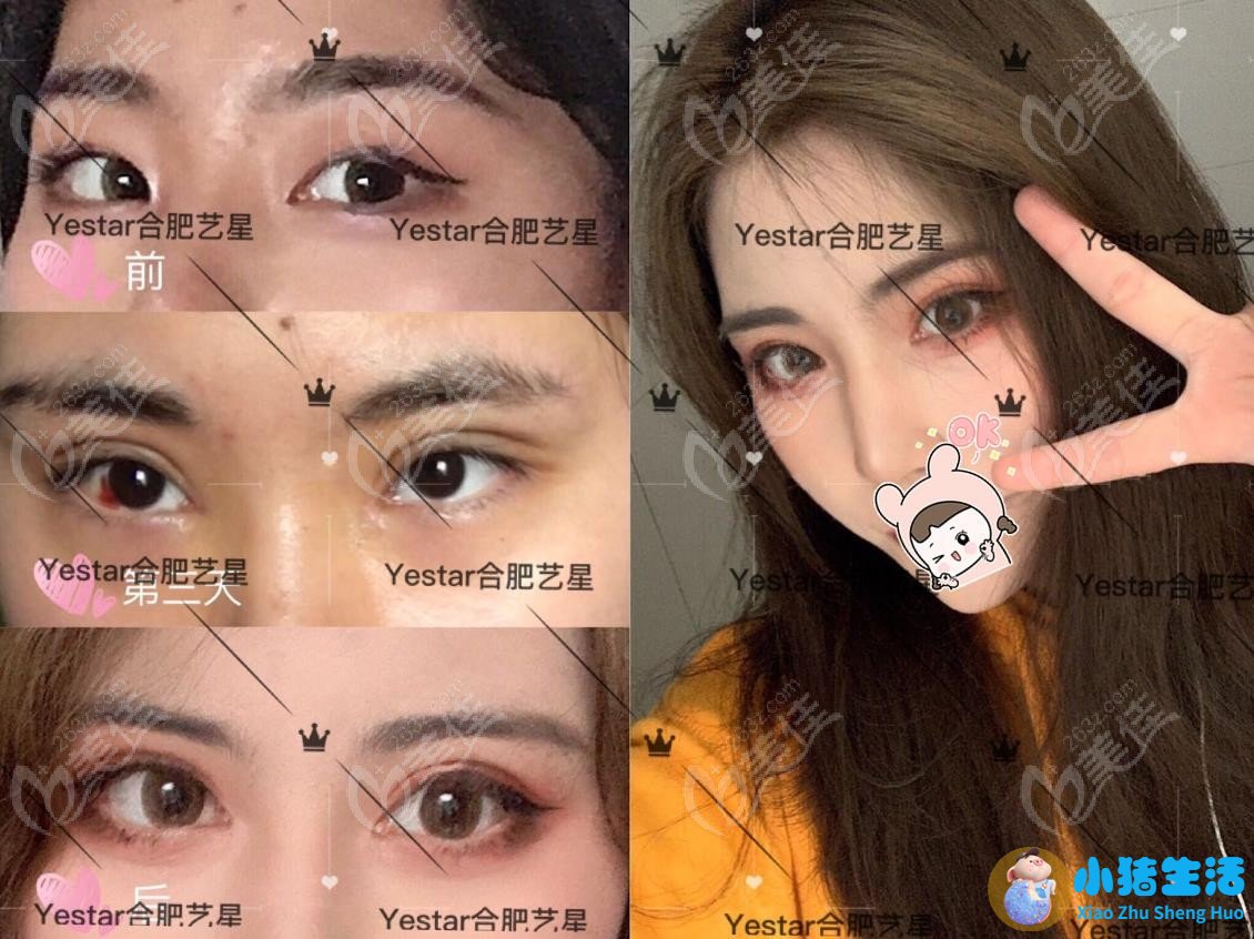 双眼皮整形失败的案例