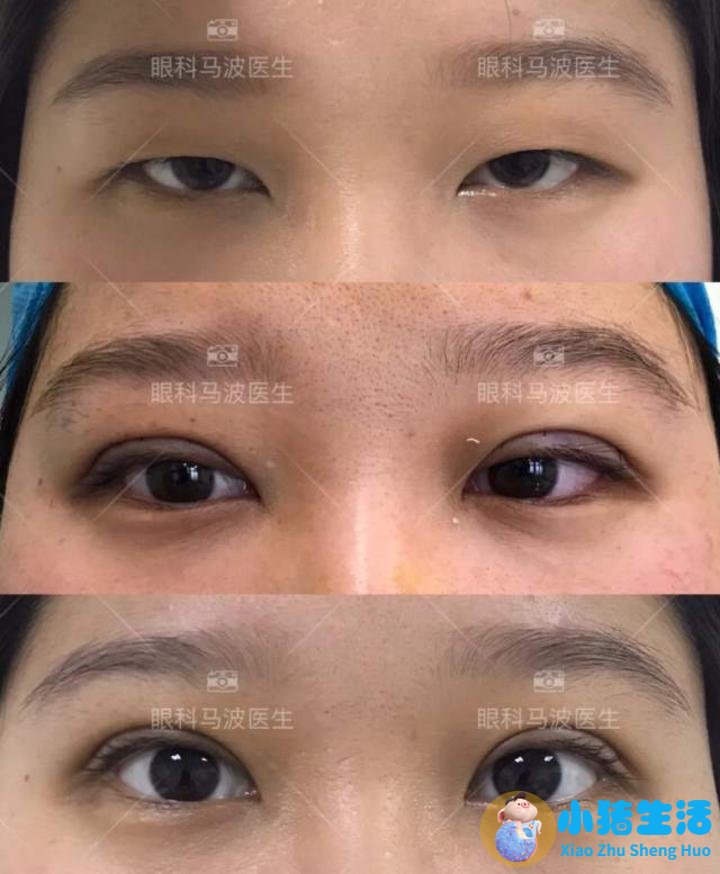 双眼皮整形失败的案例