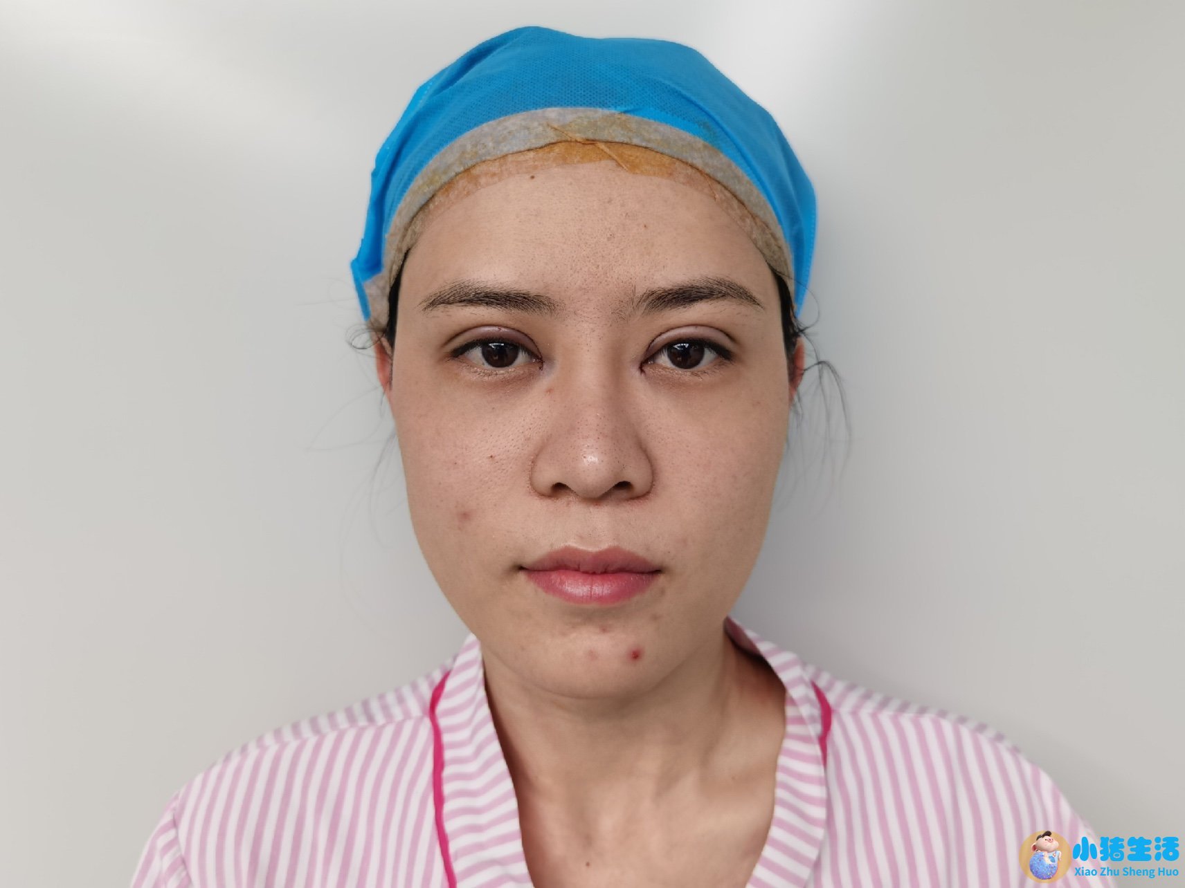 双眼皮整形失败的案例