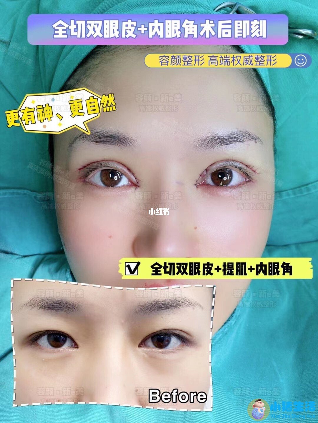 双眼皮整形失败的案例