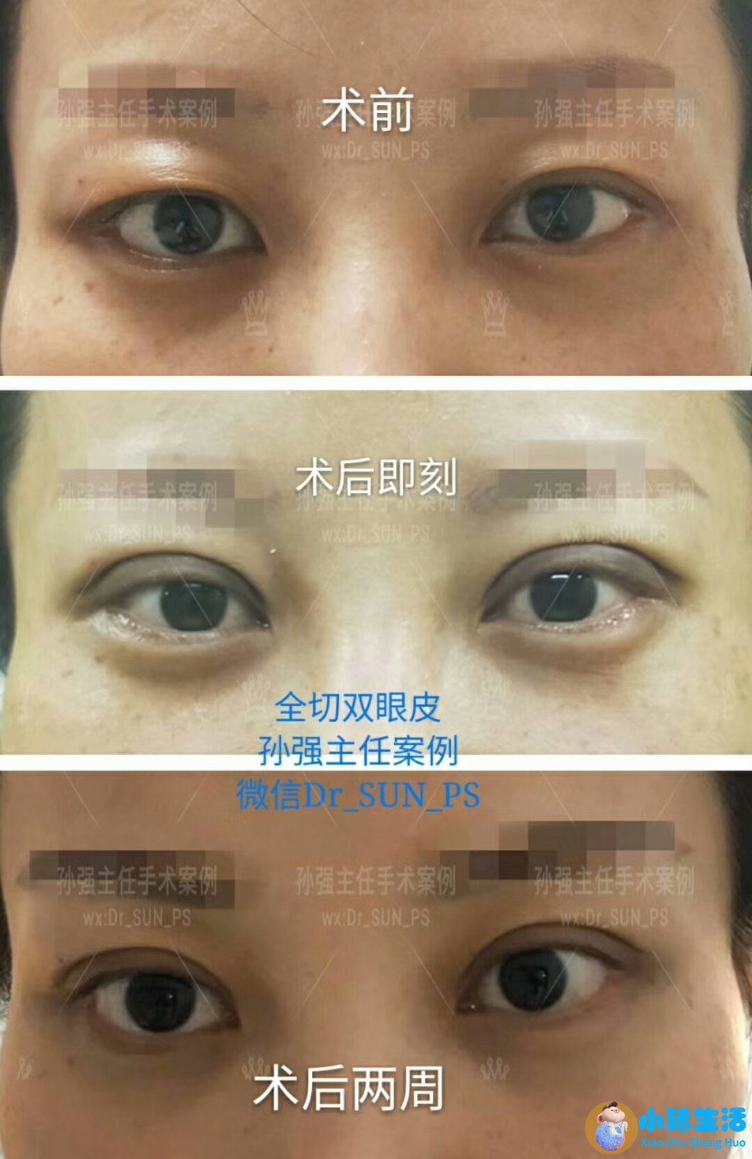 双眼皮整形失败的案例