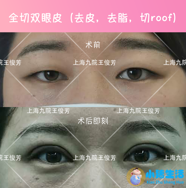 双眼皮整形失败的案例