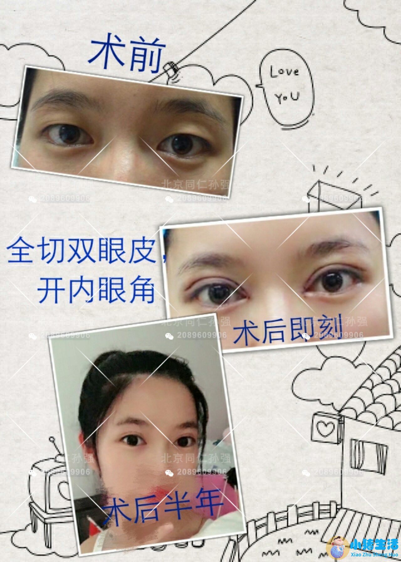 双眼皮整形失败的案例