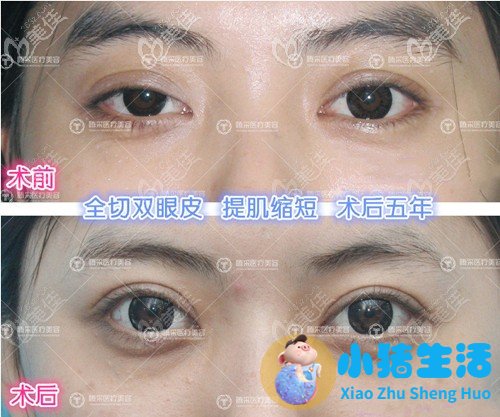双眼皮整形失败的案例