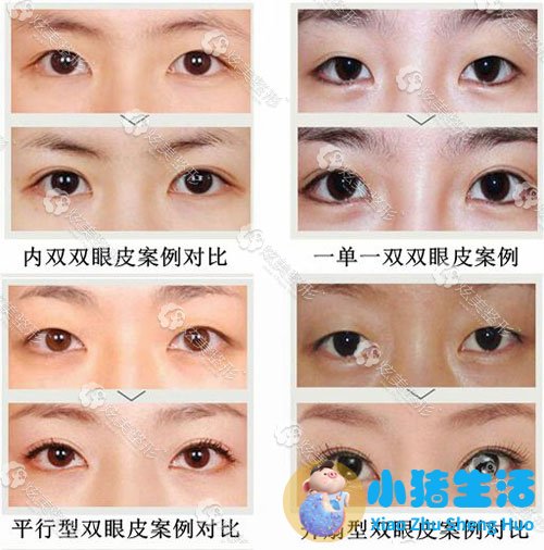 沈阳名流董红星医生双眼皮案例