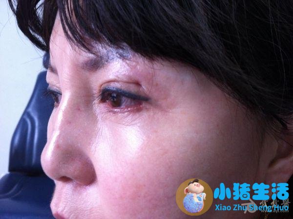 怎样才能避免双眼皮手术失败