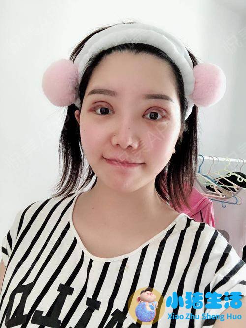双眼皮整形失败的案例