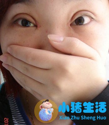 双眼皮整形失败的案例