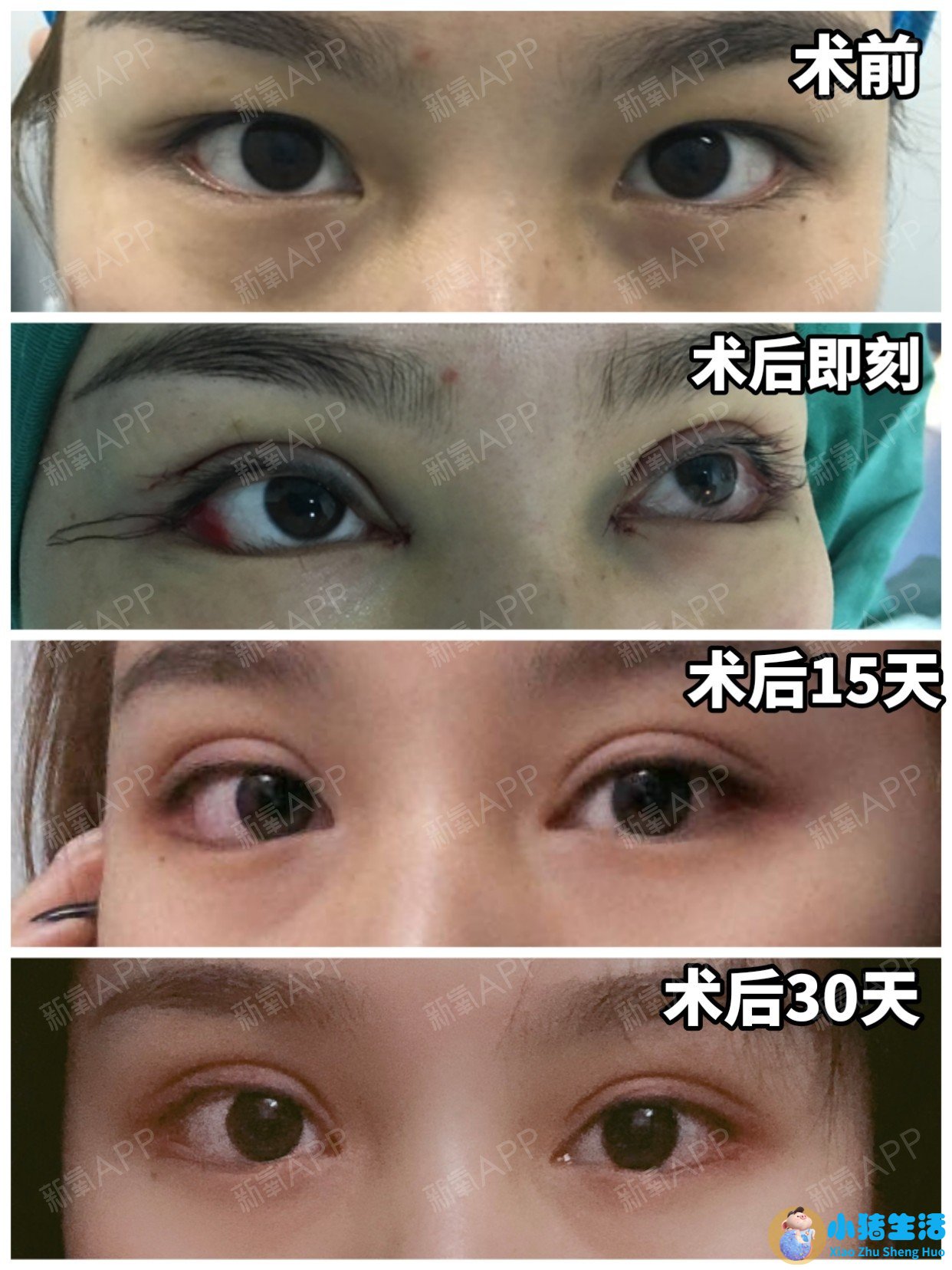 双眼皮整形失败的案例