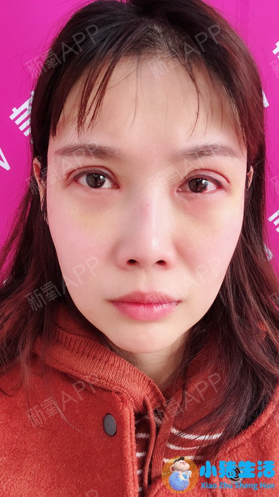 双眼皮整形失败的案例