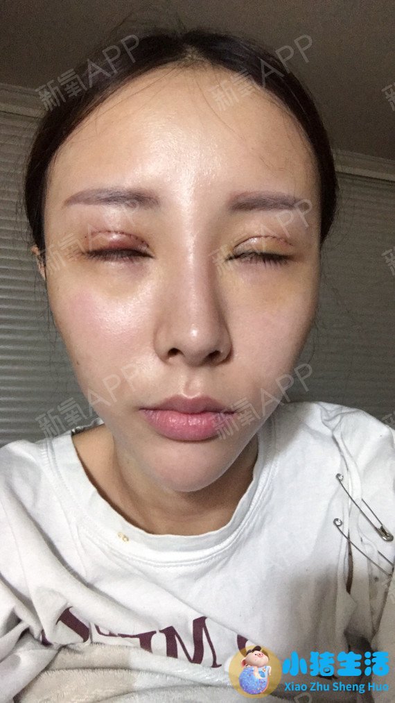 双眼皮整形失败的案例