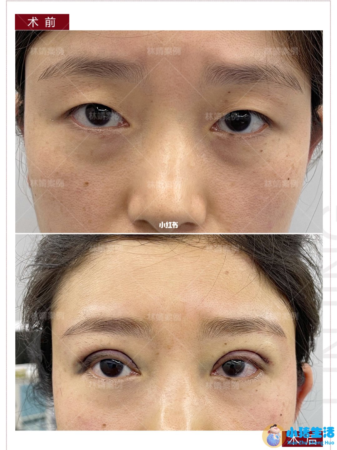 双眼皮整形失败的案例
