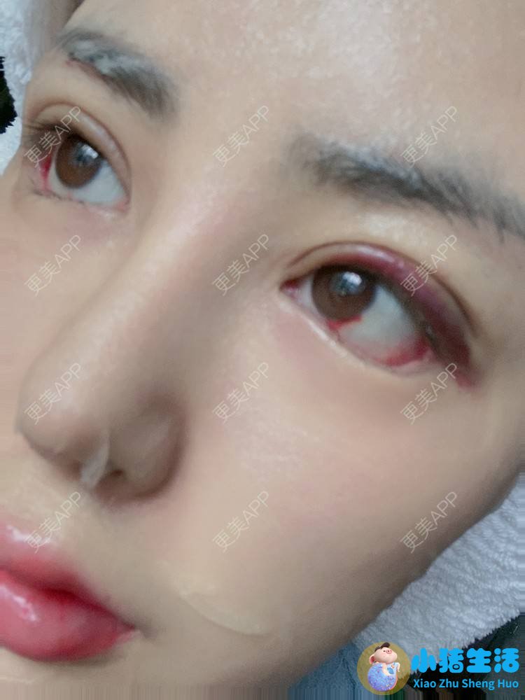 双眼皮整形失败的案例