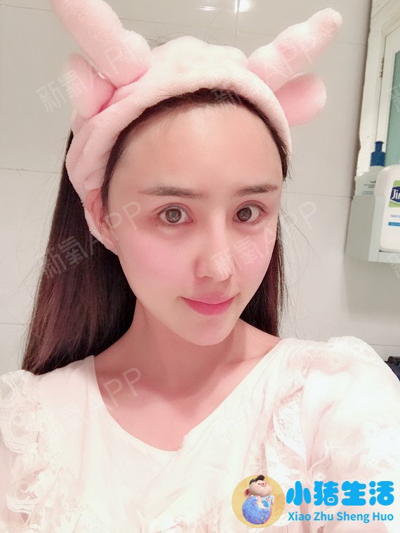 双眼皮整形失败的案例