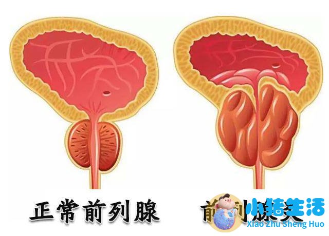 男性前列腺炎养生知识