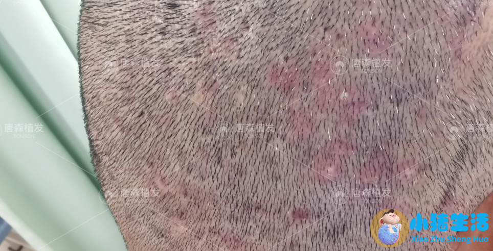 头皮上长痘痘没头发