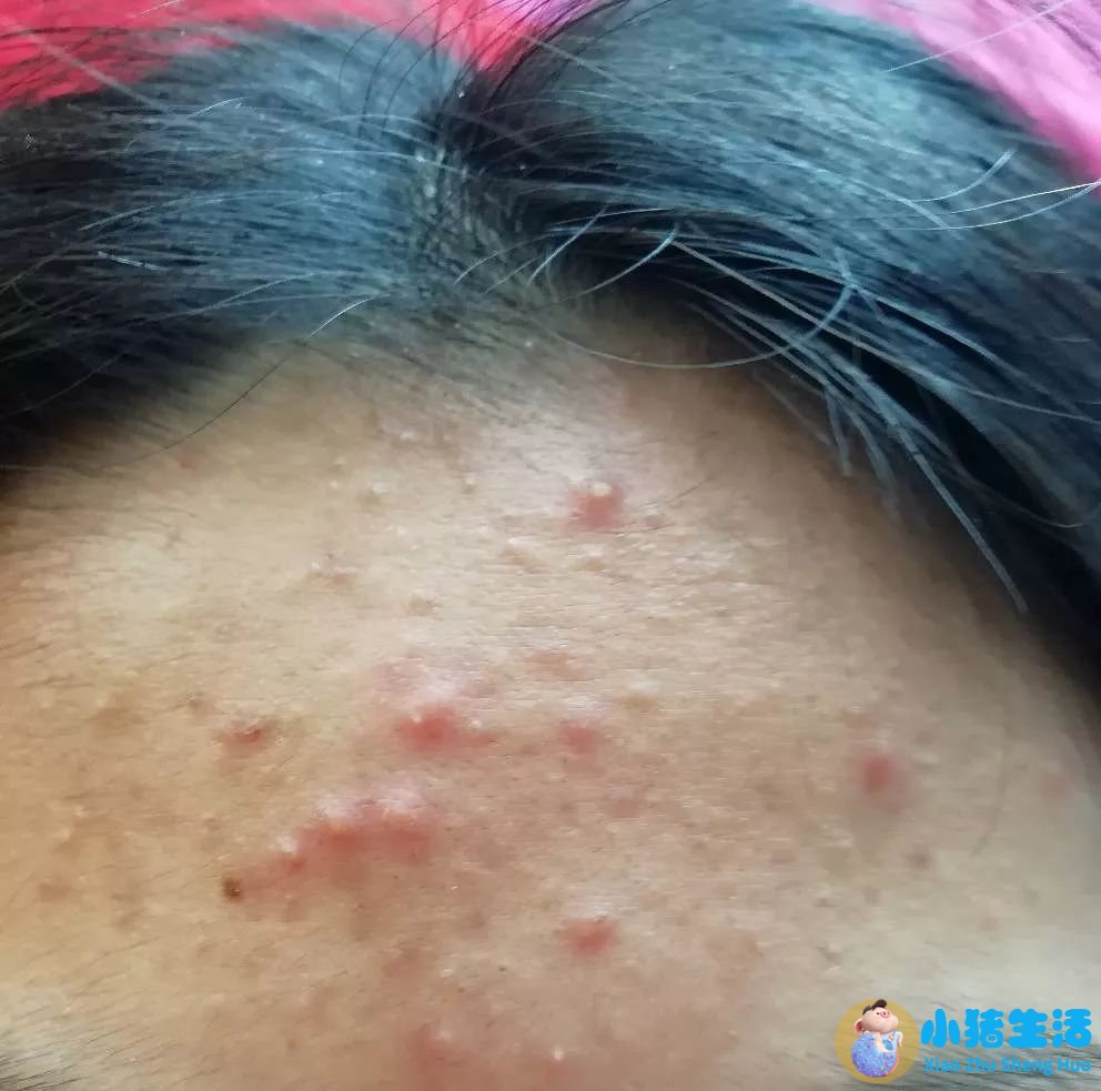 头皮上长痘痘没头发