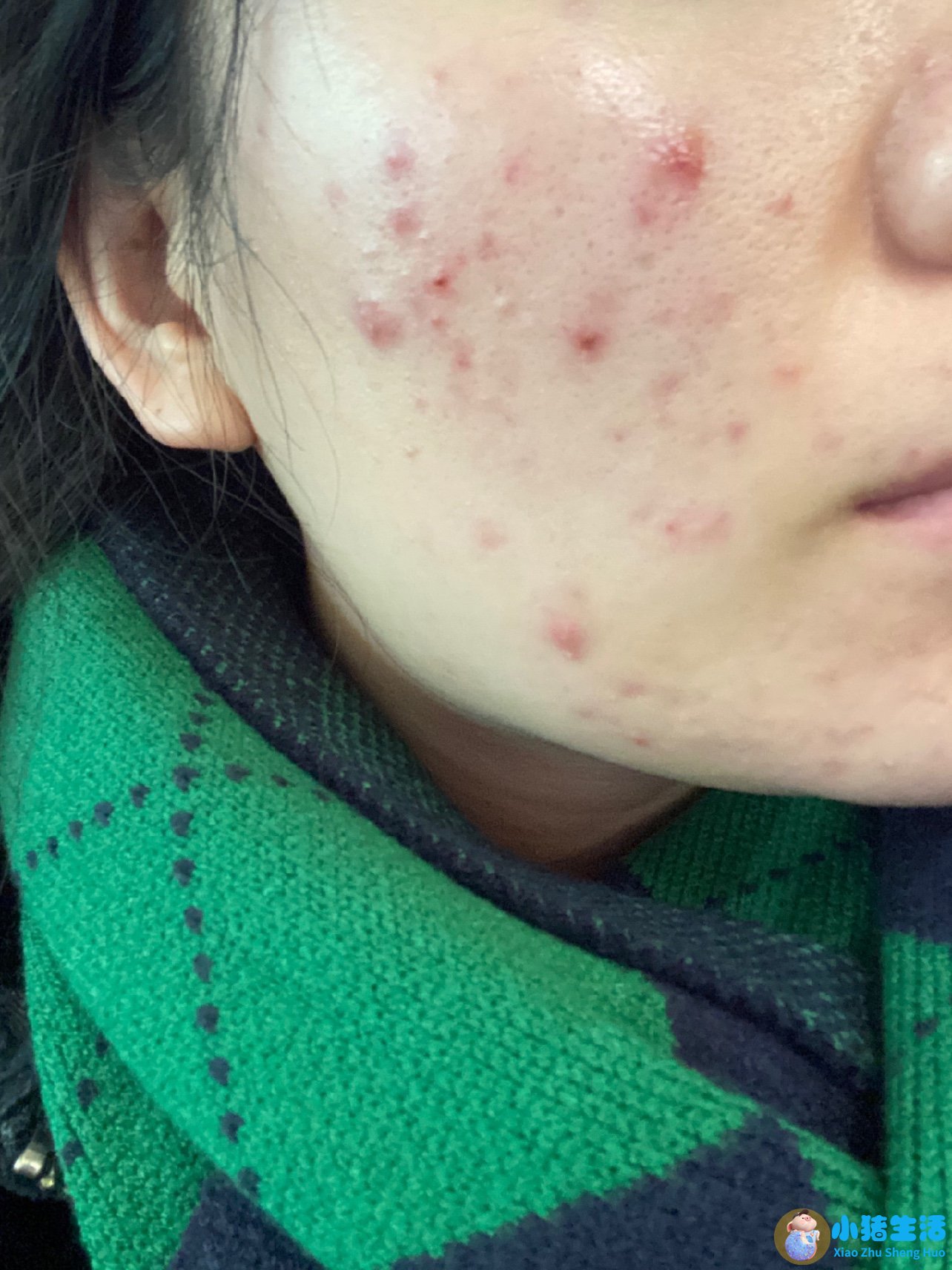 头皮上长痘痘没头发
