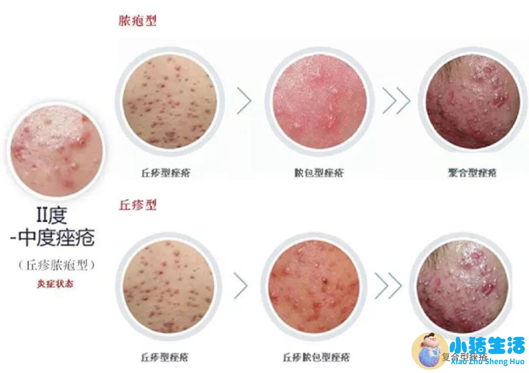 头皮上长痘痘没头发