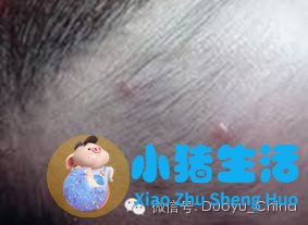 头皮上长痘痘没头发
