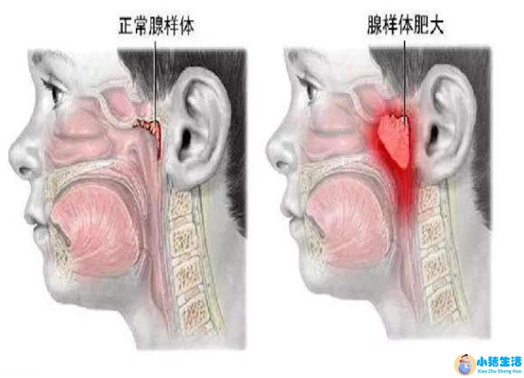 7岁娃腺样体大面容照片