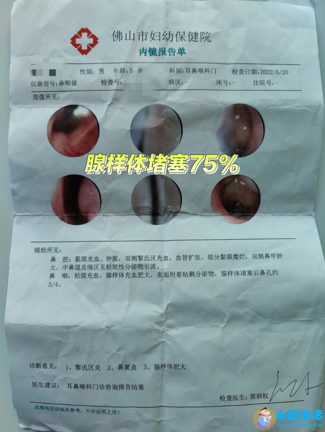 7岁娃腺样体大面容照片