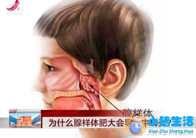 7岁娃腺样体大面容照片