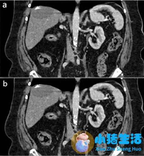 女性下腹胀是什么原因