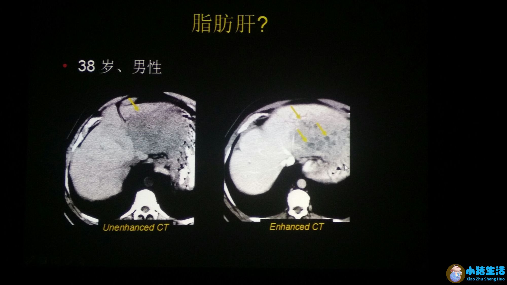 女性下腹胀是什么原因