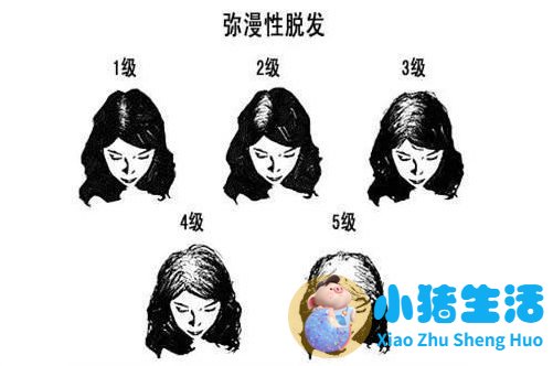 老掉头发吃什么药 脱发有哪些种类