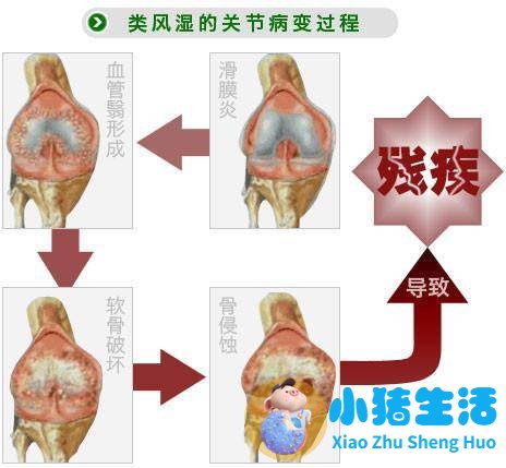 风湿可以用火烤好吗
