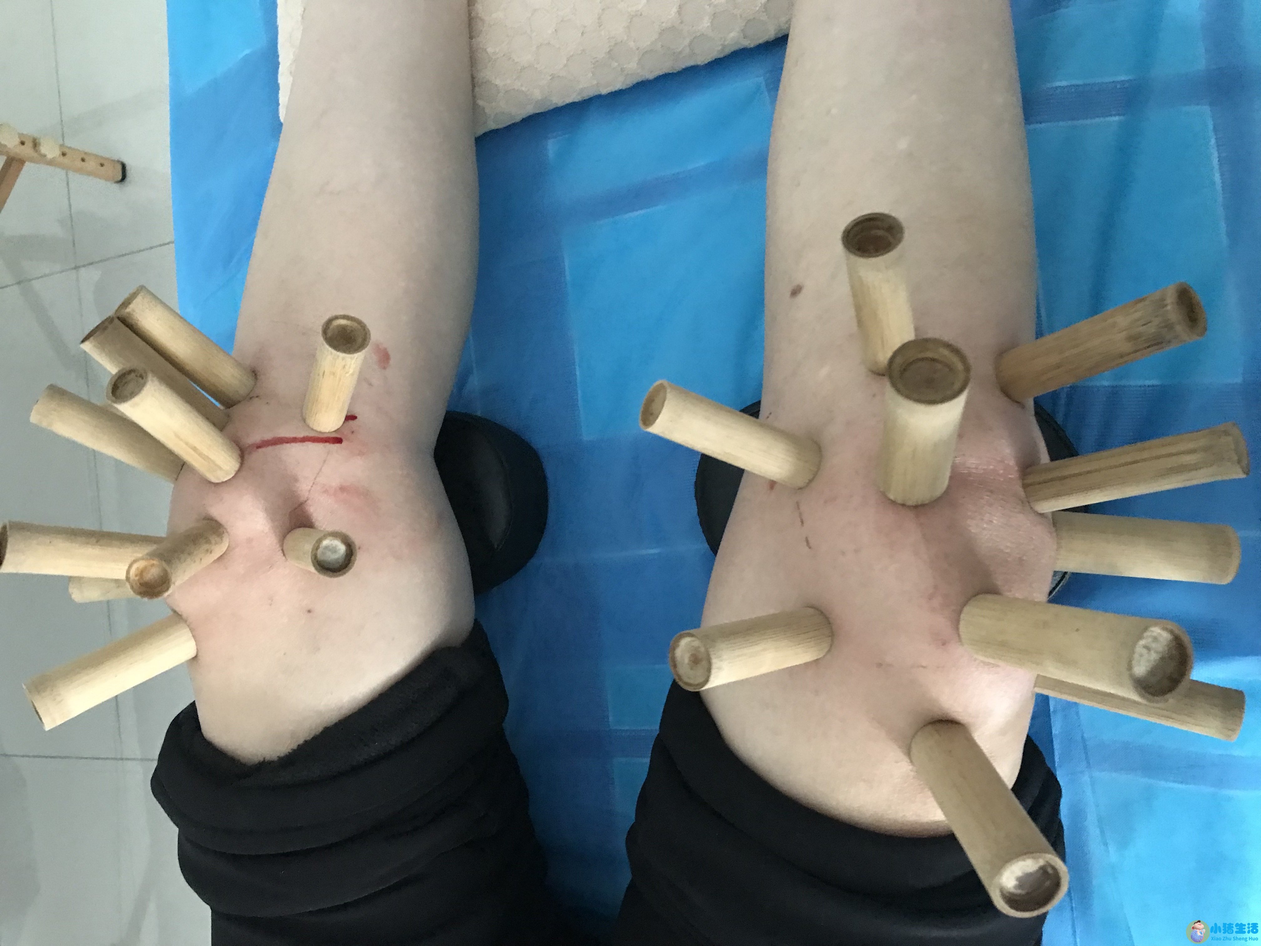 风湿可以用火烤好吗