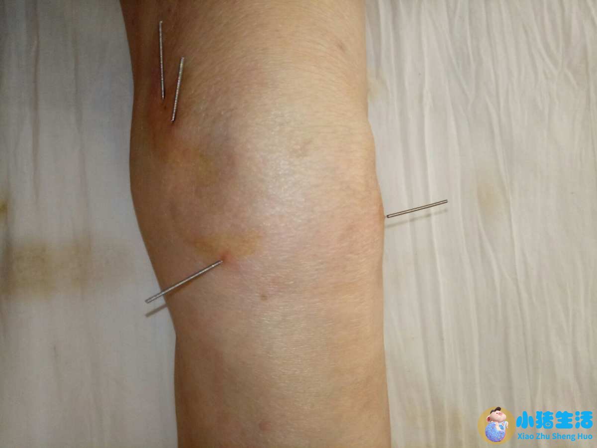 风湿可以用火烤好吗