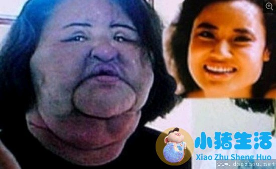 令人毛骨悚然的整容失败案例