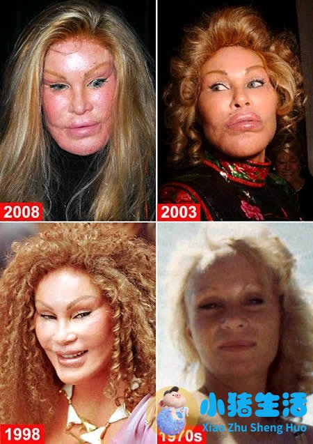 鼻子整形整容失败案例