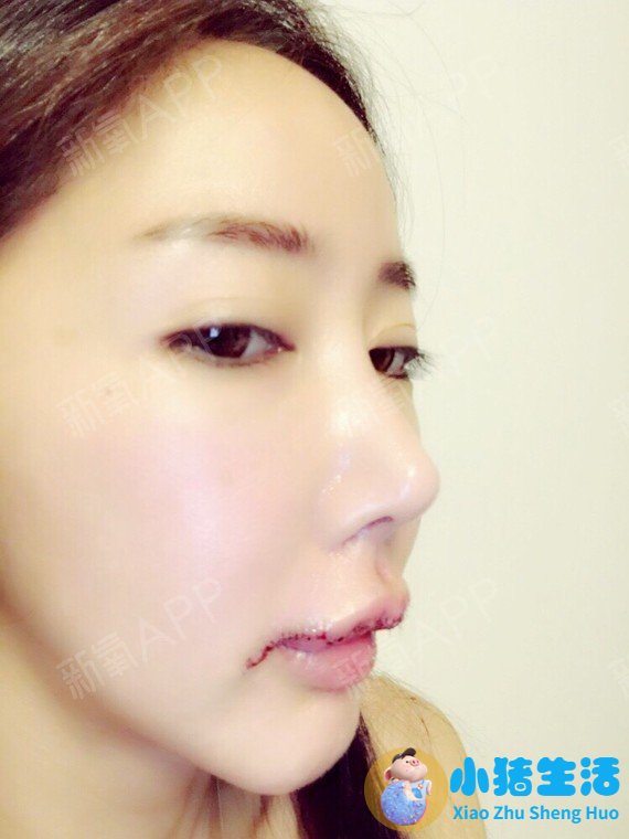 鼻子整形整容失败案例
