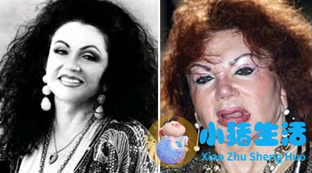 鼻子整形整容失败案例