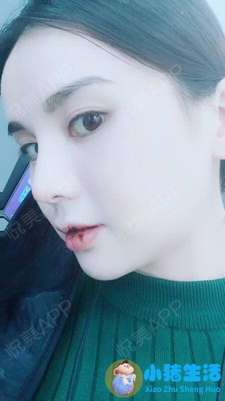 鼻子整形整容失败案例
