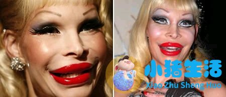 鼻子整形整容失败案例