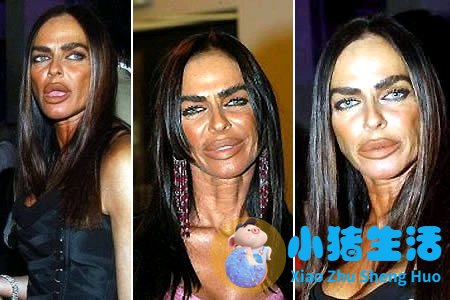 鼻子整形整容失败案例