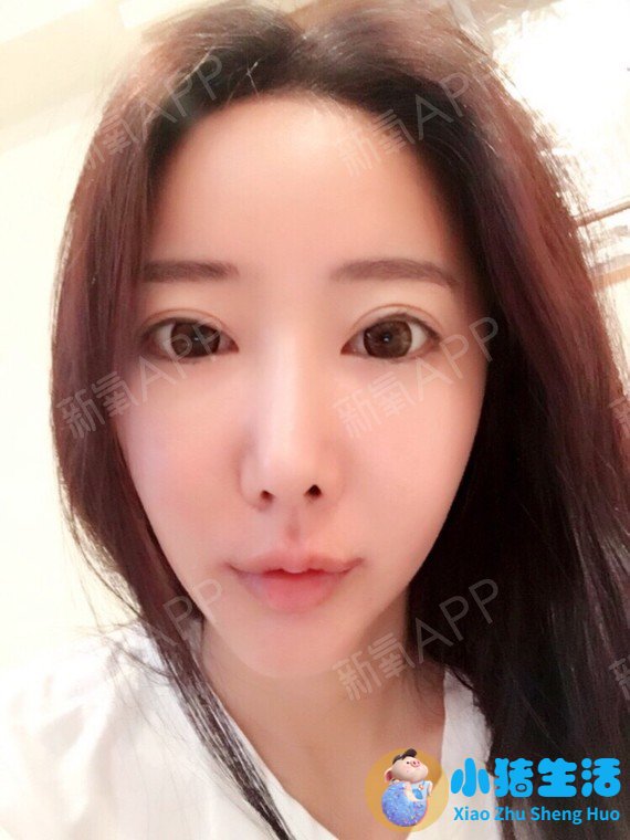 鼻子整形整容失败案例