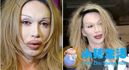 鼻子整形整容失败案例